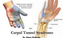 Carpel Tunnel Syndrome pain relief offered by Chiropractors of San Diego Chiropractic Massage.