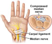 Carpal tunnel syndrome - Medical Clinic ARS: +371 67201007