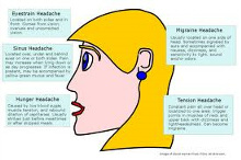 Pain relief and Treatment diagram of Migraine and Headache sufferers by chiropractors of San Diego Chiropractic and Massage, we are located in the Mira Mesa