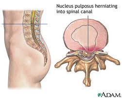 Pain relief and Treatment for herniated disc sufferers diagram by chiropractors of San Diego Chiropractic and Massage