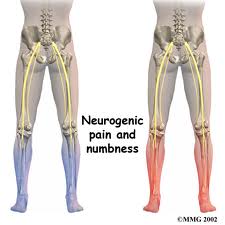 Image of neurogenic pain and numbness by chiropractors of San Diego Chiropractic and Massage